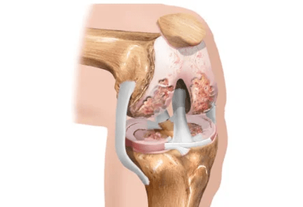 Arthrosis or arthritis of the difference