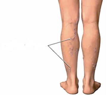 Consequences of knee arthritis