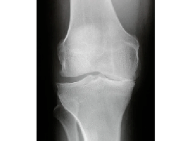 Diagnosis of knee joint disease