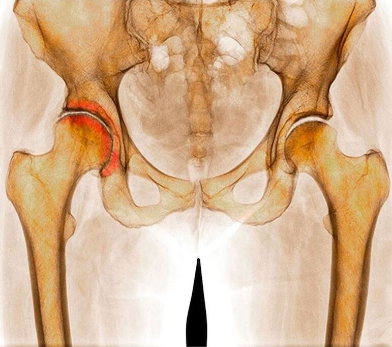 Arthrosis of hip joints