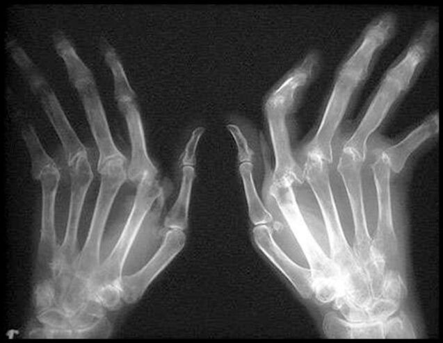 The X -Ray image of the hand is affected by arthritis