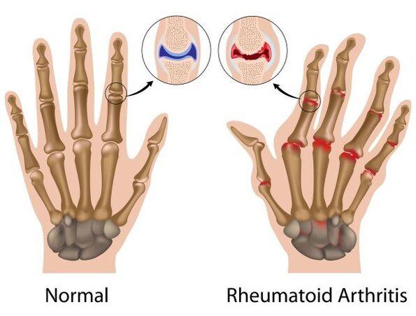 The joints of the finger are not pathological and rheumatoid arthritis