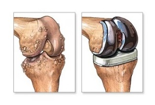 Knee replacement for joint disease
