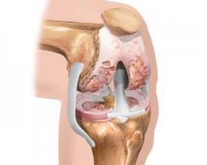 early stage of knee arthritis