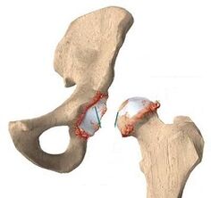 Reasons for the development of joints of the hip joint