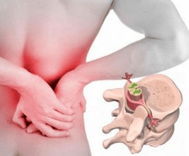 Lumbago at the beginning of osteoarthritis