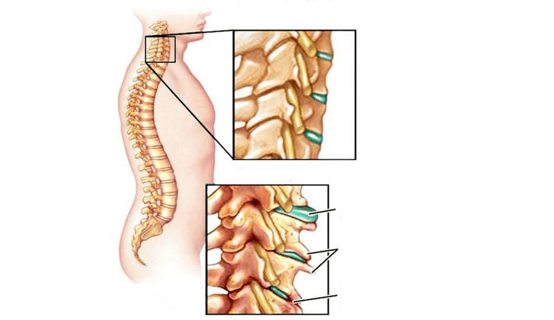 Joint syndrome