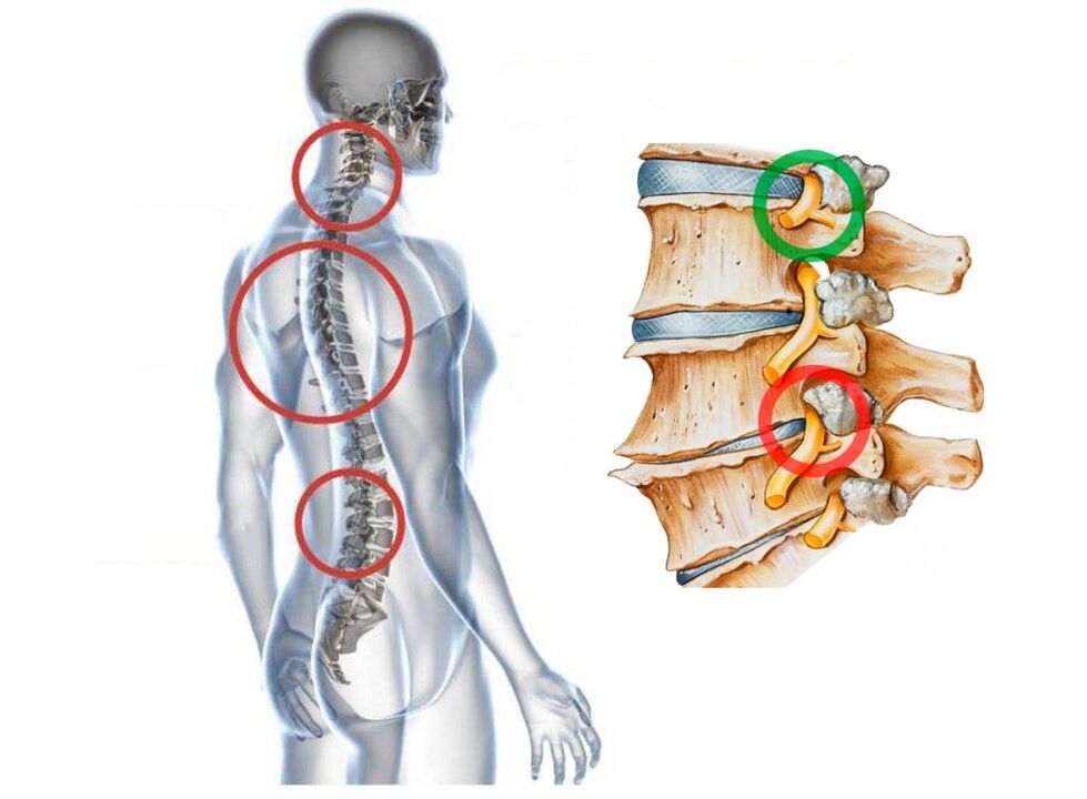 What are the vertebrae's cervical joint diseases