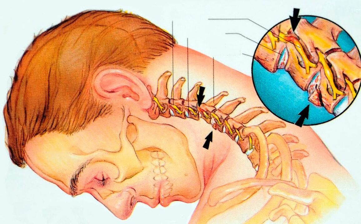 What is cervical chemical fibrosis