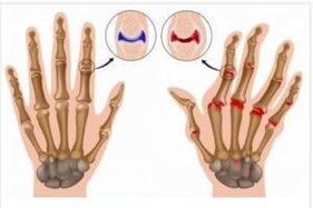 Difference between arthritis and hand arthritis