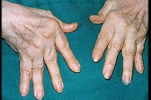 Finger arthritis symptoms