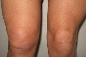 Knee arthritis with arthritis and arthrosis