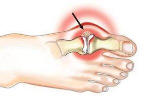 joint damage caused by arthritis and arthrosis