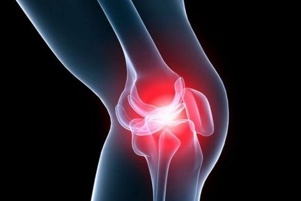 knee arthritis