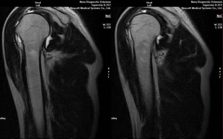 Shoulder arthritis on X-ray