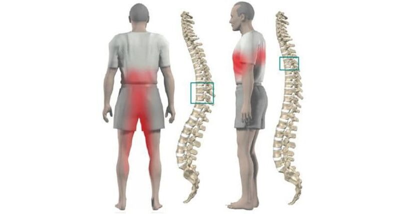 body and spine pain with osteonecrosis