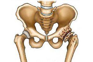 destruction of the hip joint in joint disease