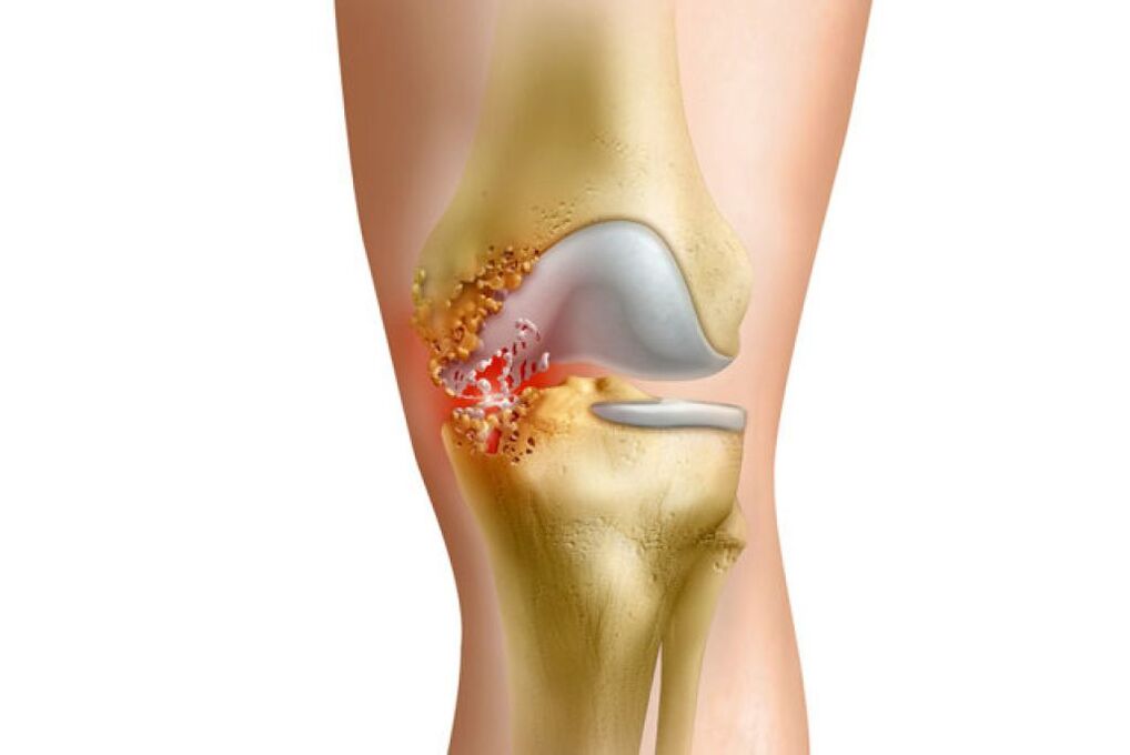 Inflammation is the cause of pain in the hip joint
