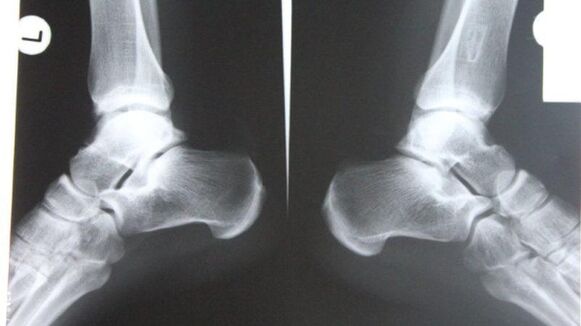 Diagnosis of ankle arthritis is by X-ray