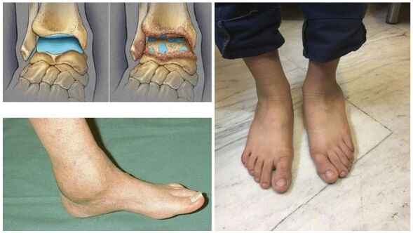 Swelling and deformity of the ankle joint due to arthritis